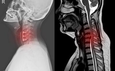 Traumatic Brain Injuries and Breathing Difficulties