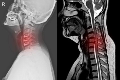 cervical rachis chirurgie spine radiculopathy douleur spinal radiculaire