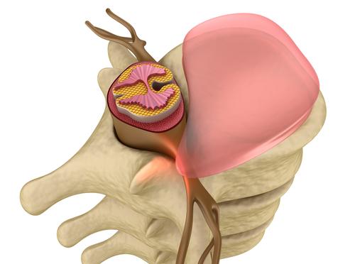 herniated-disc (1)